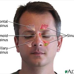 Nose And Paranasal Sinuses - Sinusitis Medication