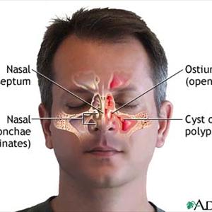 Sinus Problems Faqs - How To Cure Sinus Pain - Ways And Means To Cure Sinus Pain