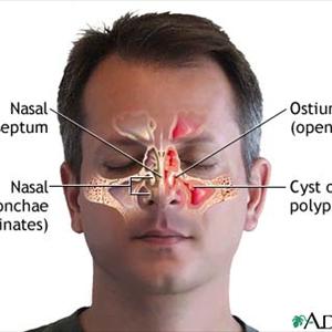  Ways And Means To Cure Sinus Pain