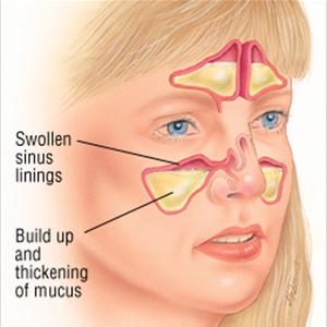  Maxilliary Sinus Disease 