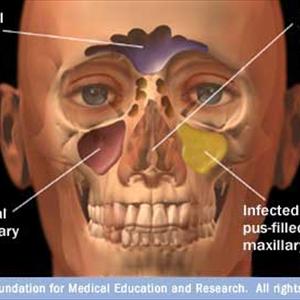 Ppt Sinusitis 