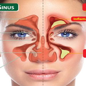 Maxillary Sinusitis Drainage - Sinus Infections - Why Antibiotics For Sinus Infections Don