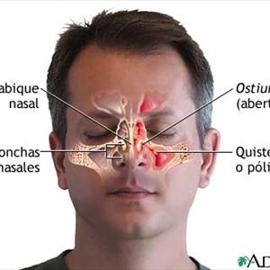 Sinusitis Patient - Various Causes And Possible Treatment Of Sinus Infection