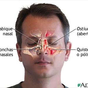 Gum Inflammation Sinusitis 