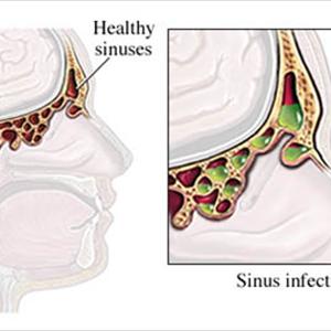 Acute Sinusitis Fatigue 