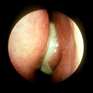 Sinus Doctor Abbr - Recurring Sinus Infection - An Explanation?