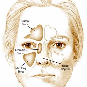 Sinusitis Eye Floaters 