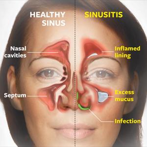 Sinuses Cause Dizziness 