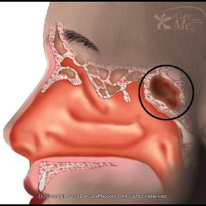 Sinus Track - Relieving Sinus Infections And Sinus Pressure In 24 Hours