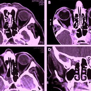 Acute Ethmoidal Sinusitis - Treat Your Sinusitis Right