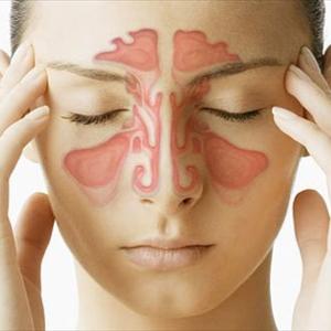 Bacterial Sinusitis Signs 