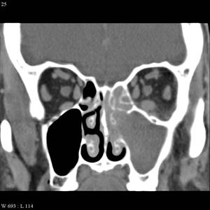 Acute Maxillary Sinus - Causes, Symptoms And Treatment Of Sinusitis