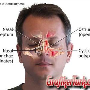 Sinusitis Tratamientos Naturales 