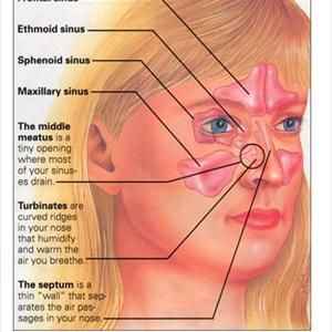 Sinusitis Alergia - Don