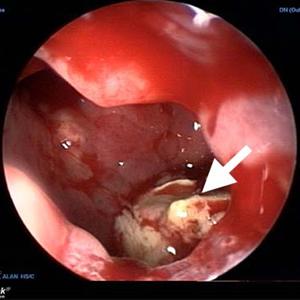 Fungal Sinusitis Drainage 