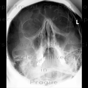 Paranasal Sinuses Anatomy 