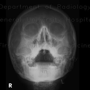 Sinusitis Diseases - Why Does Sinus Drainage Make You Cough? - Nurse