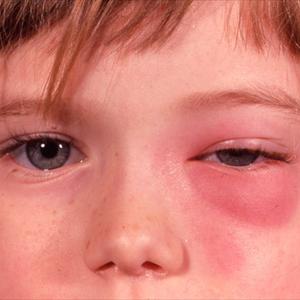 Sinus Cysts In Humans - Chronic Sinusitis Cure Should Not Be A Problem