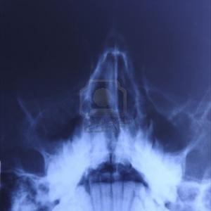Sinus Frontalis - Why Lock Yourself From The Various Sinus Treatments