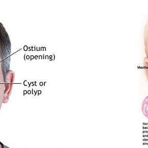 Frontal Sphenoid Sinuses 