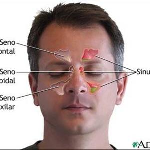 Sinusitis Treatment Of - Major Symptoms Of Sinus Infection