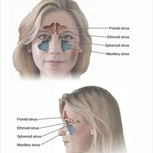 Sphenoid Sinusitis Brain Infection 