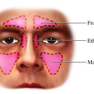 Sphenoid Sinus Polyps - Sinusitis Cure