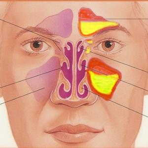 Undeveloped Frontal Sinuses - Sinus Headache Symptoms, Knowing Is The First Step To Prevention