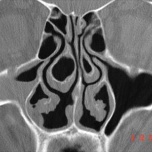 Acute Sinusitis Management - Deal With Pathological Headaches The Natural Way