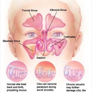 Enfermedad Sinusitis - Cure Your Sinusitis At Home