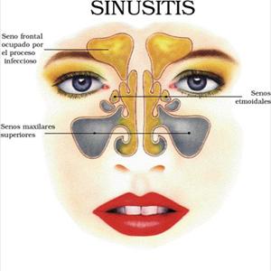 sinuses sinusitis sinus mucous disease fungal jaw ears popping cures inflammation chronic natural infections infection treatment