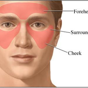 Maxillary Sinuses Relief - Sinusitis And Biofilms - An Introduction - Part 2