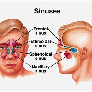Inflamed Ethmoid Sinuses - Your Neighbor Has Acute Sinusitis How Can You Help