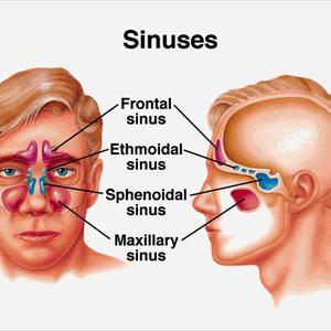  Your Neighbor Has Acute Sinusitis How Can You Help