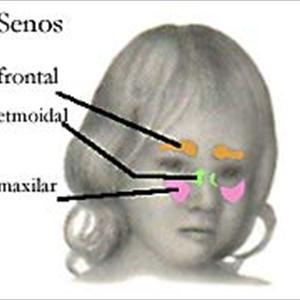  Treating Sinus Disease