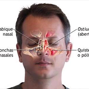 Sinuses Drainage - What Is Cavernous Sinus? - Know More About Cavernous Sinus