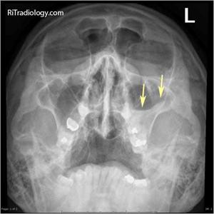 Sinus Doctor Abbreviation - How To Relieve Sinus Pressure