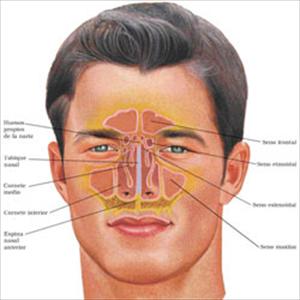 Allergic Fungal Sinusitis Specialist - Natural Home Remedies For Sinus Infections - How To Get Better Without Any Side Effects